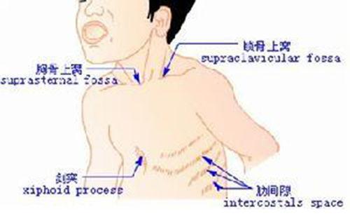 胸凹陷图片,探寻美丽背后的健康秘密